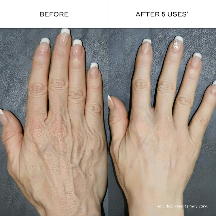 A side-by-side before and after comparison of a human hand, showing a reduction in visible veins and skin texture after five uses. The left side is labeled 'BEFORE' and the right side is labeled 'AFTER 5 USES'.