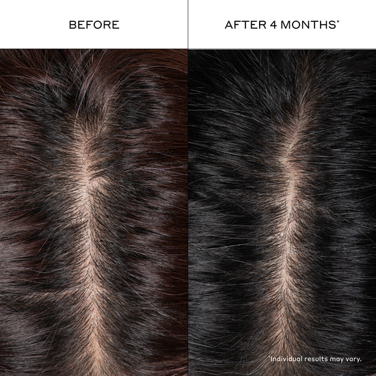 Before and after comparison of hair thickness after 4 months, showing a significant increase in hair density.