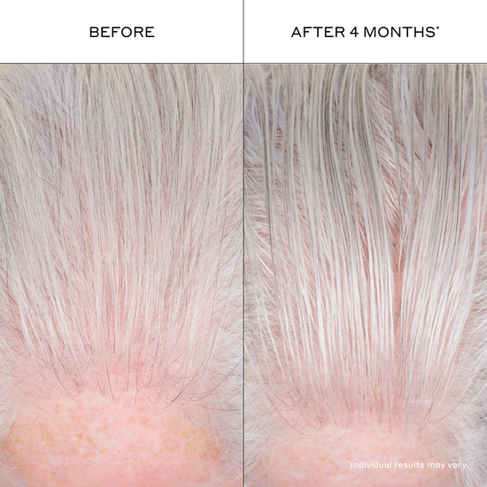 Before and after comparison of hair growth on a scalp with visible hair density increase.