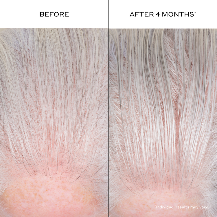 Before and after comparison of hair growth on a scalp with visible hair density increase.