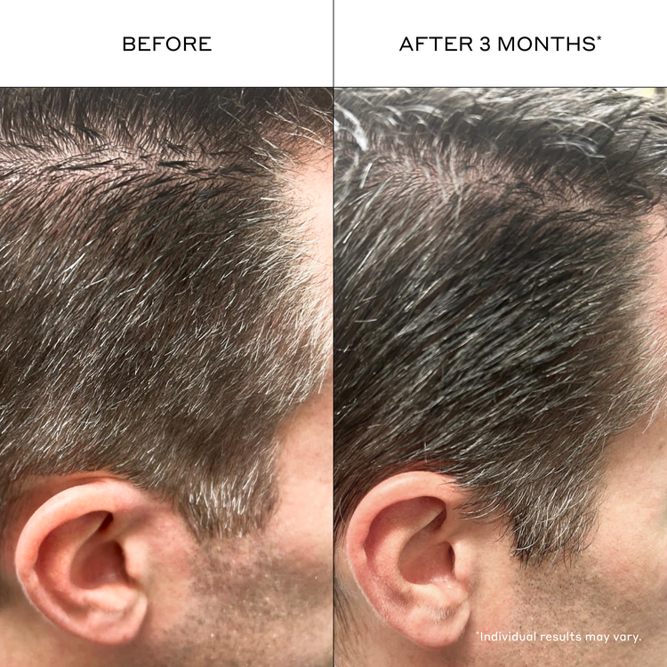 Before and after comparison of hair growth on a person's head, showing a significant increase in hair density.