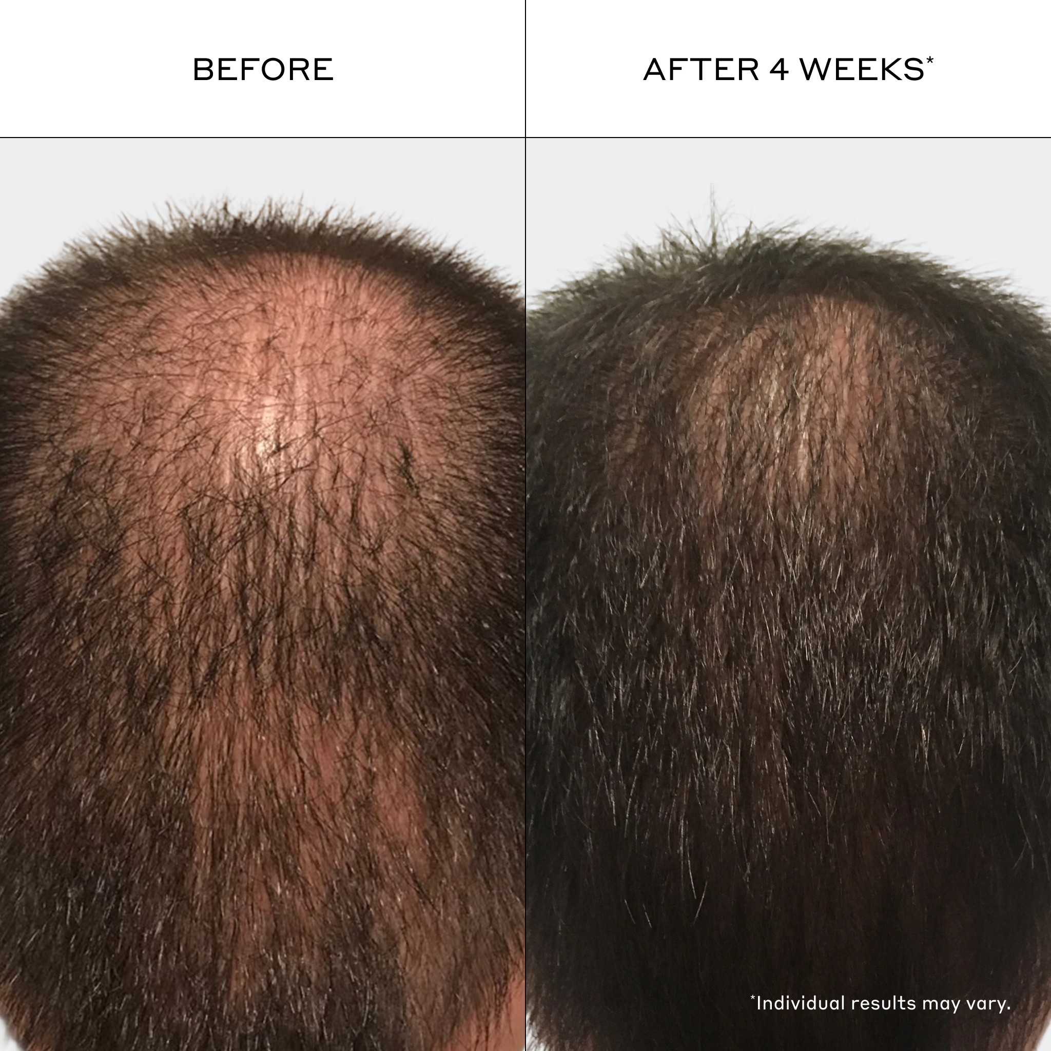 Before and after comparison of hair growth treatment on a person's head.