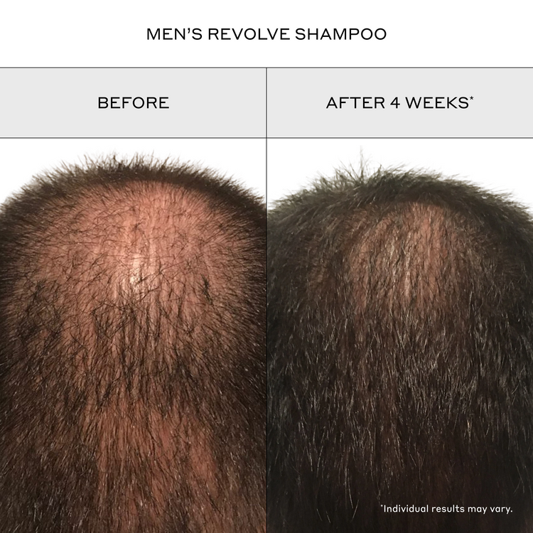 Before and after comparison of a man's scalp with hair density improvement after 4 weeks of use of Men's Revolve Shampoo. The left side shows thinning hair and visible scalp, while the right side shows denser hair.