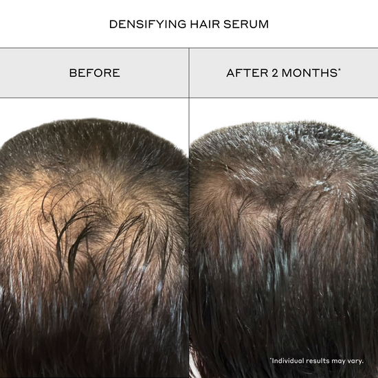 Before and after comparison of a person's thinning hair at the crown, labeled 'DENSIFYING HAIR SERUM' with 'BEFORE' on the left and 'AFTER 2 MONTHS*' on the right.