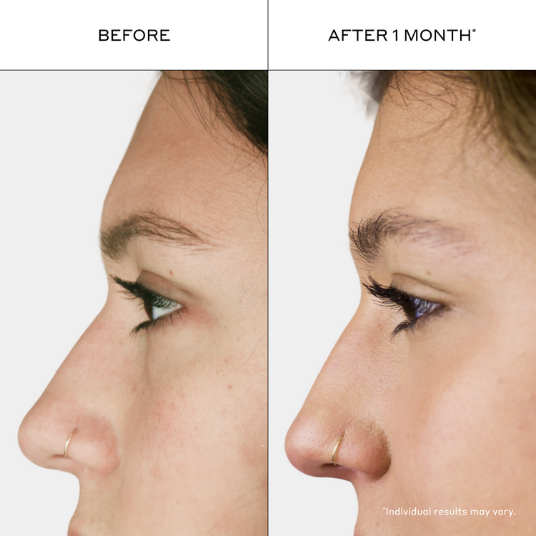 Side-by-side before and after comparison of a woman's profile showing the tip of her nose, with text reading 'BEFORE' and 'AFTER 1 MONTH' and a note saying 'Individual results may vary.'.