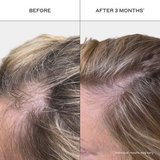 Before and after comparison of hair growth treatment on a person's scalp.